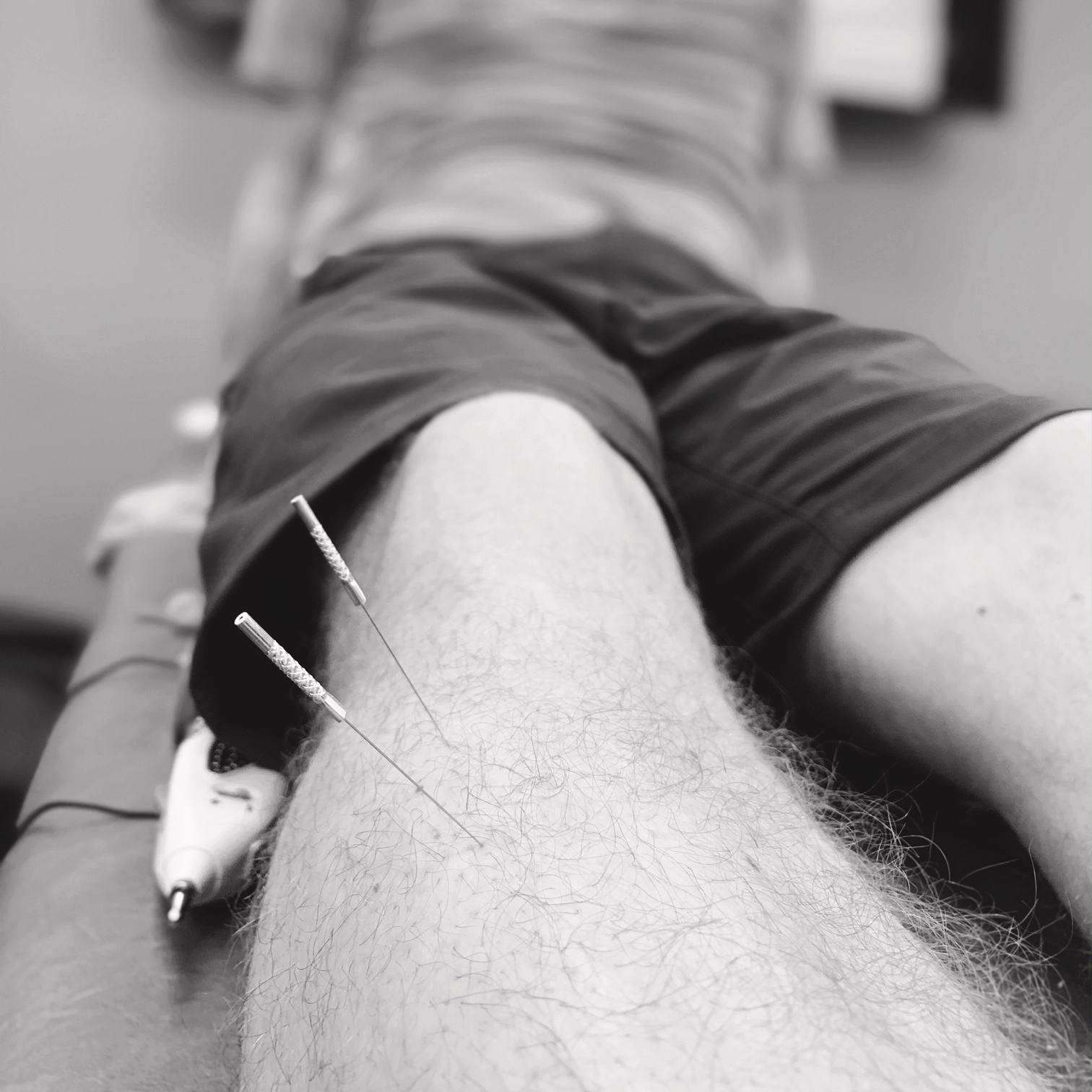 Dry needling - Current Physical Therapy