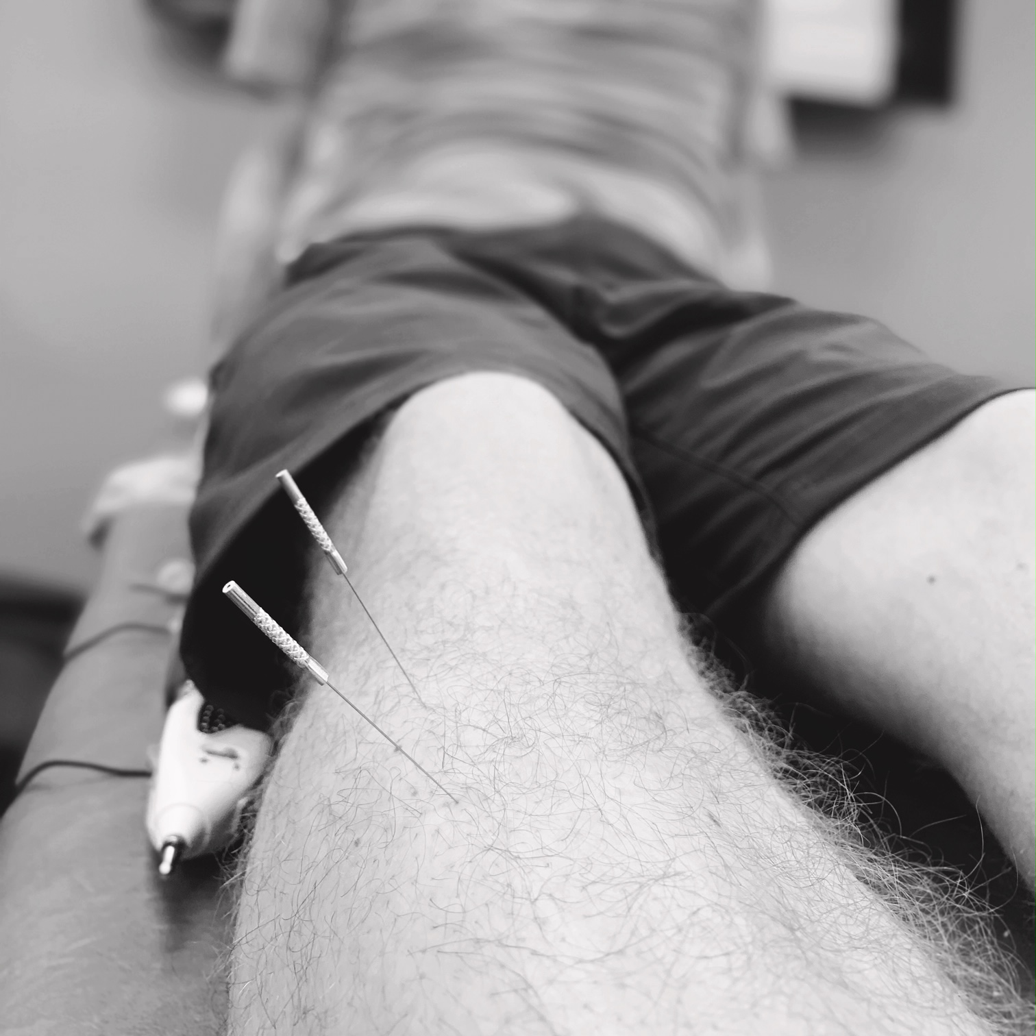 Dry Needling Dry needling - Current Physical Therapy