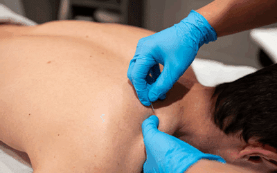 Dry Needling: Modern Relief for Muscle Pain