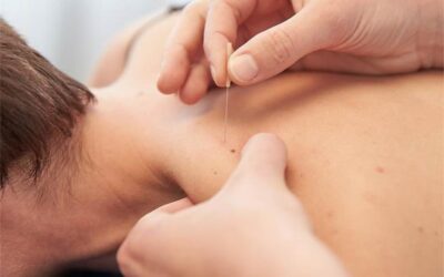 What Is Dry Needling and Is It Safe A Physical Therapist Explains
