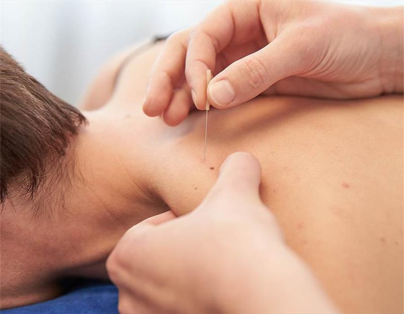 What Is Dry Needling and Is It Safe A Physical Therapist Explains